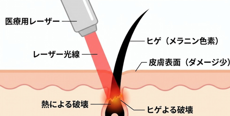 シロノクリニックの麻酔代は高い？1級FPが解説する痛みと費用の考え方に関する画像。医療用レーザーがヒゲのメラニン色素に反応し、熱で毛根を破壊するメカニズムの解説図解を中心に解説する1級FPが解説する40代女性・男性向けの医療脱毛・全身脱毛・自己投資・ミニマムライフ・経済的自由達成のための医療脱毛投資戦略ガイドのビジュアル。
