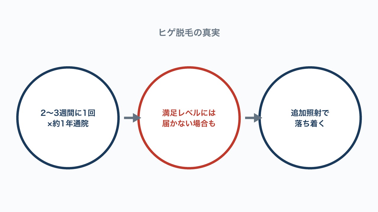ヒゲ脱毛の真実を示す3ステップ図解。1年通院しても満足レベルに届かない場合があり追加照射で落ち着く流れ。