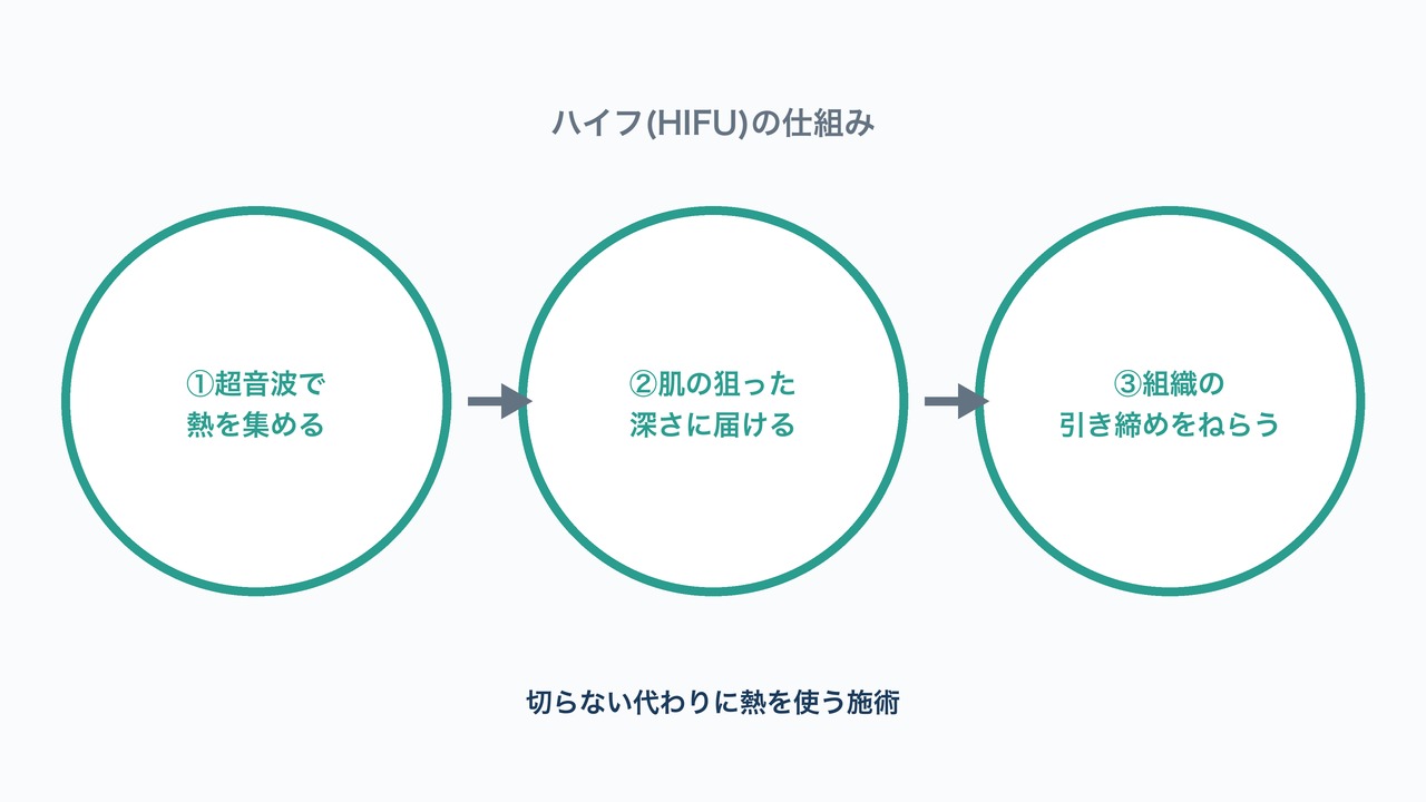 ハイフ(HIFU)の仕組みの図解。超音波で熱を集め肌の深さに届け組織の引き締めをねらう3ステップ。